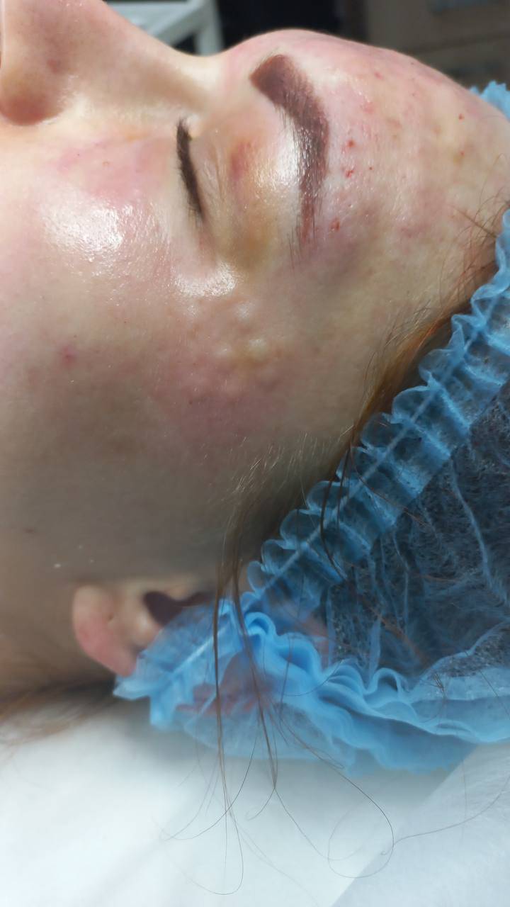 Біоревіталізація (40-60 хв)