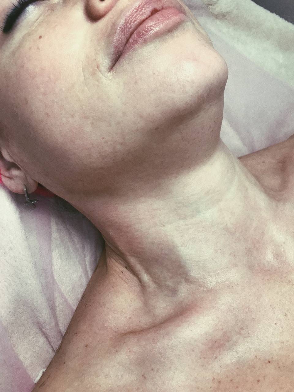 Мезотерапія шиї та декольте (60 хв)