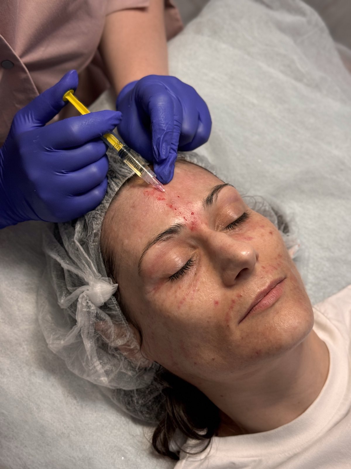 Мезотерапія обличчя (60 хв)