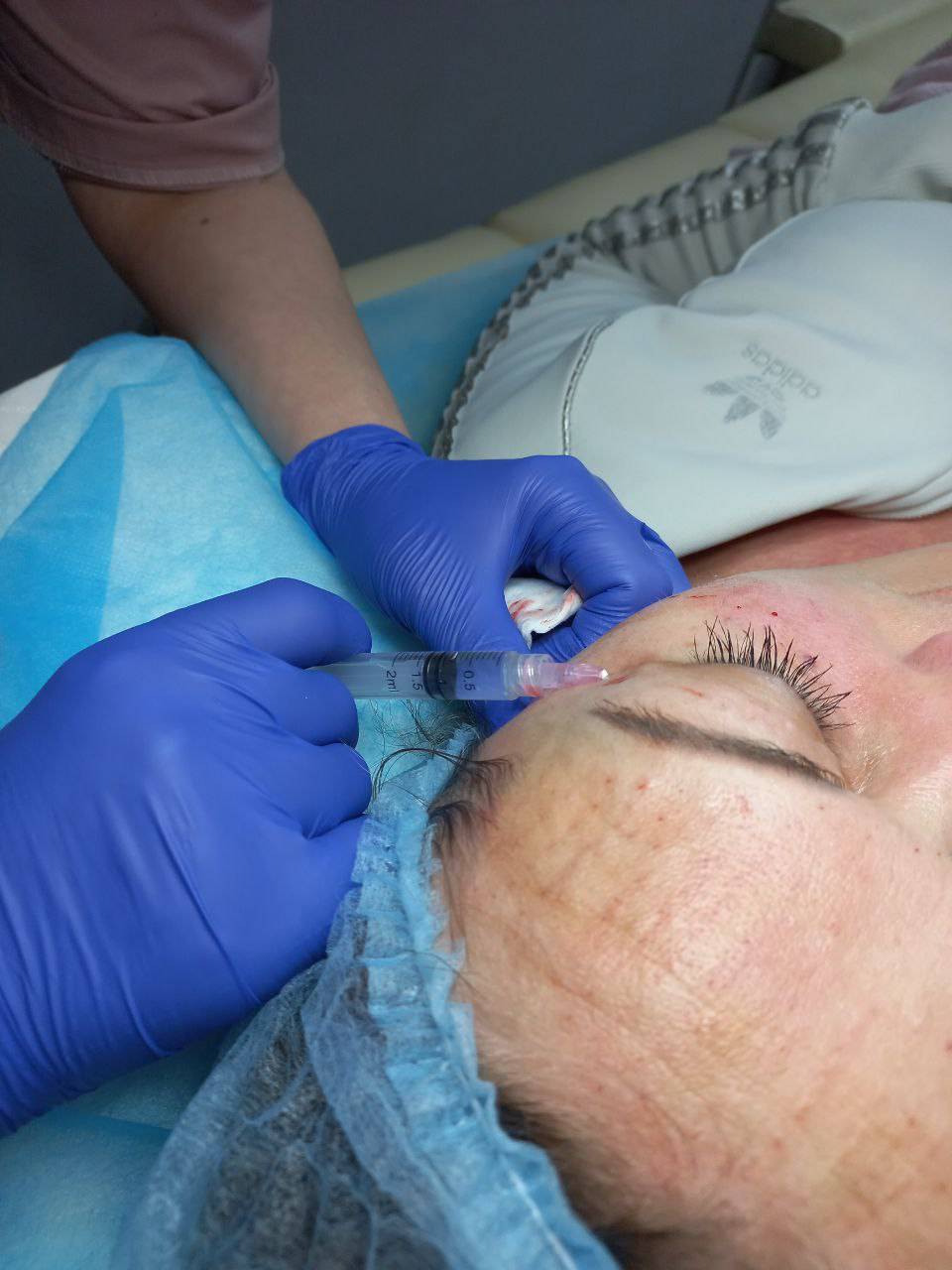 Біоревіталізація (40-60 хв)