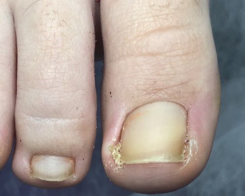 Видалення піднігтьового мозоля встановлення темпонади (один нігтик)